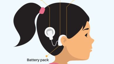 Cochlear Implant